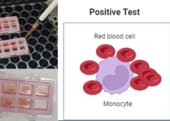 ಕಸ್ತೂರ್ಬಾ ವೈದ್ಯಕೀಯ ಕಾಲೇಜು ಮತ್ತು ಆಸ್ಪತ್ರೆ ಮಣಿಪಾಲದ ಟ್ರಾನ್ಸ್ಫ್ಯೂಷನ್ ಮೆಡಿಸಿನ್ ಸೆಂಟರ್ ಸಂಕೀರ್ಣ ಹೊಂದಾಣಿಕೆಯಾಗದ ರಕ್ತದ ಸುರಕ್ಷಿತ ವರ್ಗಾವಣೆಗಾಗಿ “MMA” ಅನ್ನು ಪರಿಚಯಿಸಿದೆ.!!