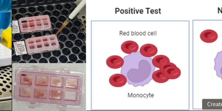 ಕಸ್ತೂರ್ಬಾ ವೈದ್ಯಕೀಯ ಕಾಲೇಜು ಮತ್ತು ಆಸ್ಪತ್ರೆ ಮಣಿಪಾಲದ ಟ್ರಾನ್ಸ್ಫ್ಯೂಷನ್ ಮೆಡಿಸಿನ್ ಸೆಂಟರ್ ಸಂಕೀರ್ಣ ಹೊಂದಾಣಿಕೆಯಾಗದ ರಕ್ತದ ಸುರಕ್ಷಿತ ವರ್ಗಾವಣೆಗಾಗಿ “MMA” ಅನ್ನು ಪರಿಚಯಿಸಿದೆ.!!