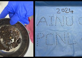 ವ್ಯಕ್ತಿಯೊಬ್ಬರಿಂದ ಸುಮಾರು 418 ಕಿಡ್ನಿ ಸ್ಟೋನ್ ಹೊರ ತೆಗೆದ ವೈದ್ಯರು…!!