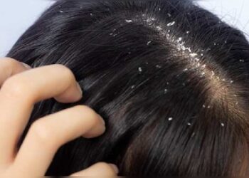 ತಲೆಹೊಟ್ಟಿಗೆ ವಿದಾಯ ಹೇಳಿ: ಮನೆಯಲ್ಲೇ ಸಿಗುವ 4 ನೈಸರ್ಗಿಕ ಪರಿಹಾರಗಳು…!